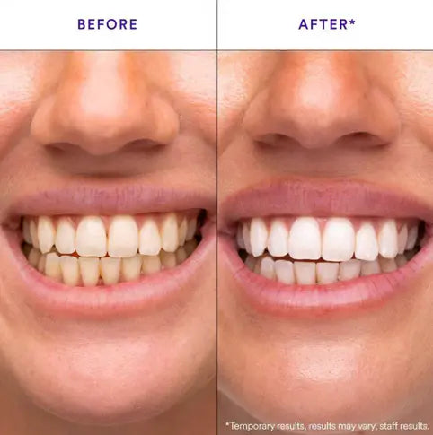 Teeth Whitening Strips